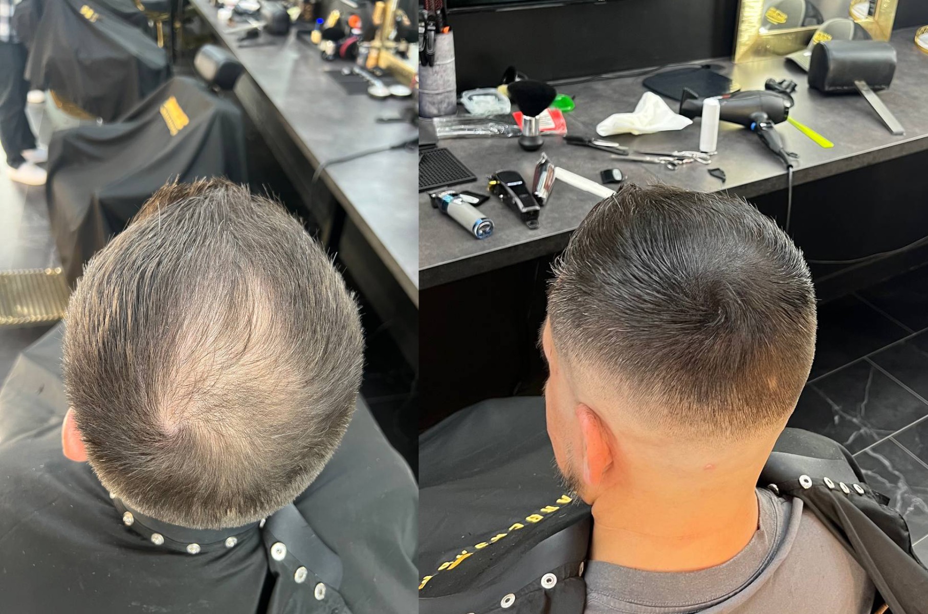 correction-calvitie-mcc-2