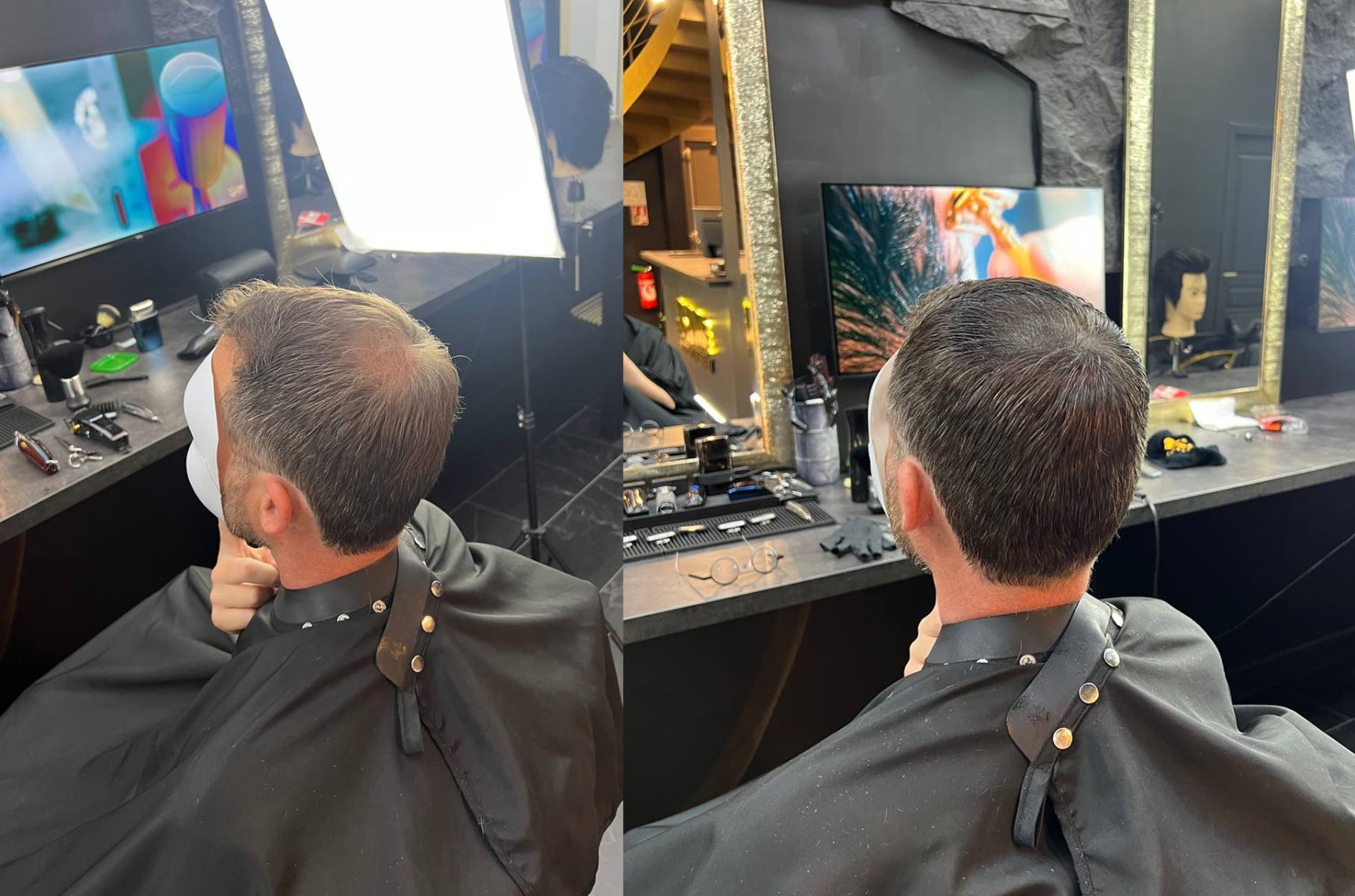 correction-calvitie-mcc-4